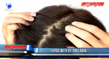 90后加入脱发行列 医生：劳逸结合 保证休息