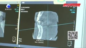 牙齿缺失怎么办 口腔专家表示：应及时修复