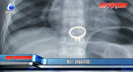 “熊孩子”误吞钻戒 吓坏家人