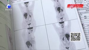 患者身上巨大肿瘤被判“死刑” 妙手医生成功切除让生命“回春”